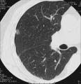肺がん参考図