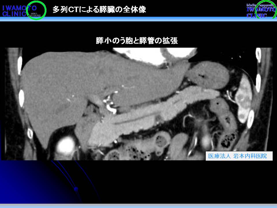 Iwamoto-膵臓CT写真