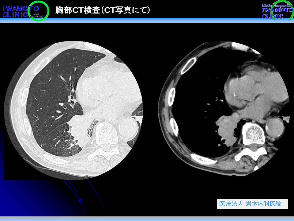 胸部CT検査（CT写真）