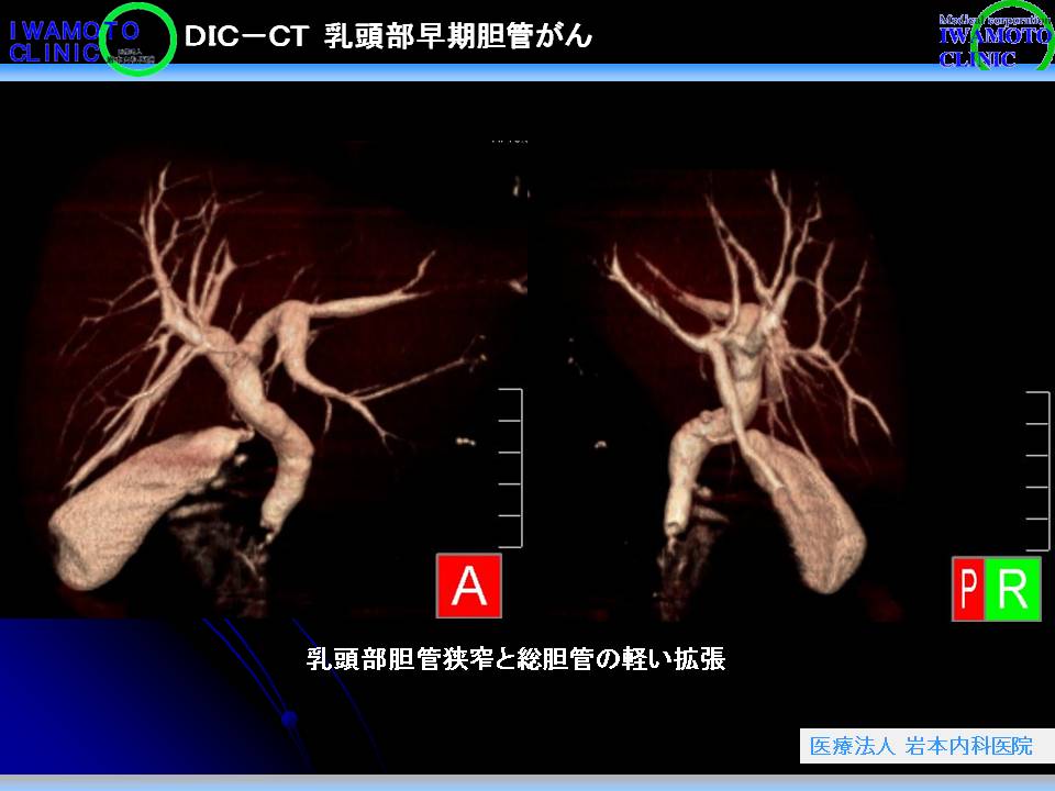 DIC-CT　乳頭部早期胆管がん
