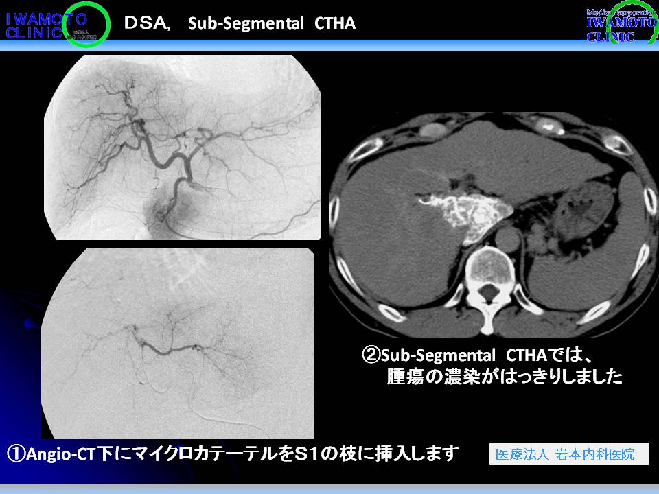 DSA Sub-segmental CTHA