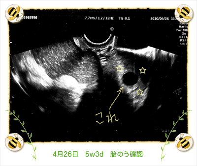 Ueicocca 妊娠２ヶ月 ３ヶ月のエコー画像一覧